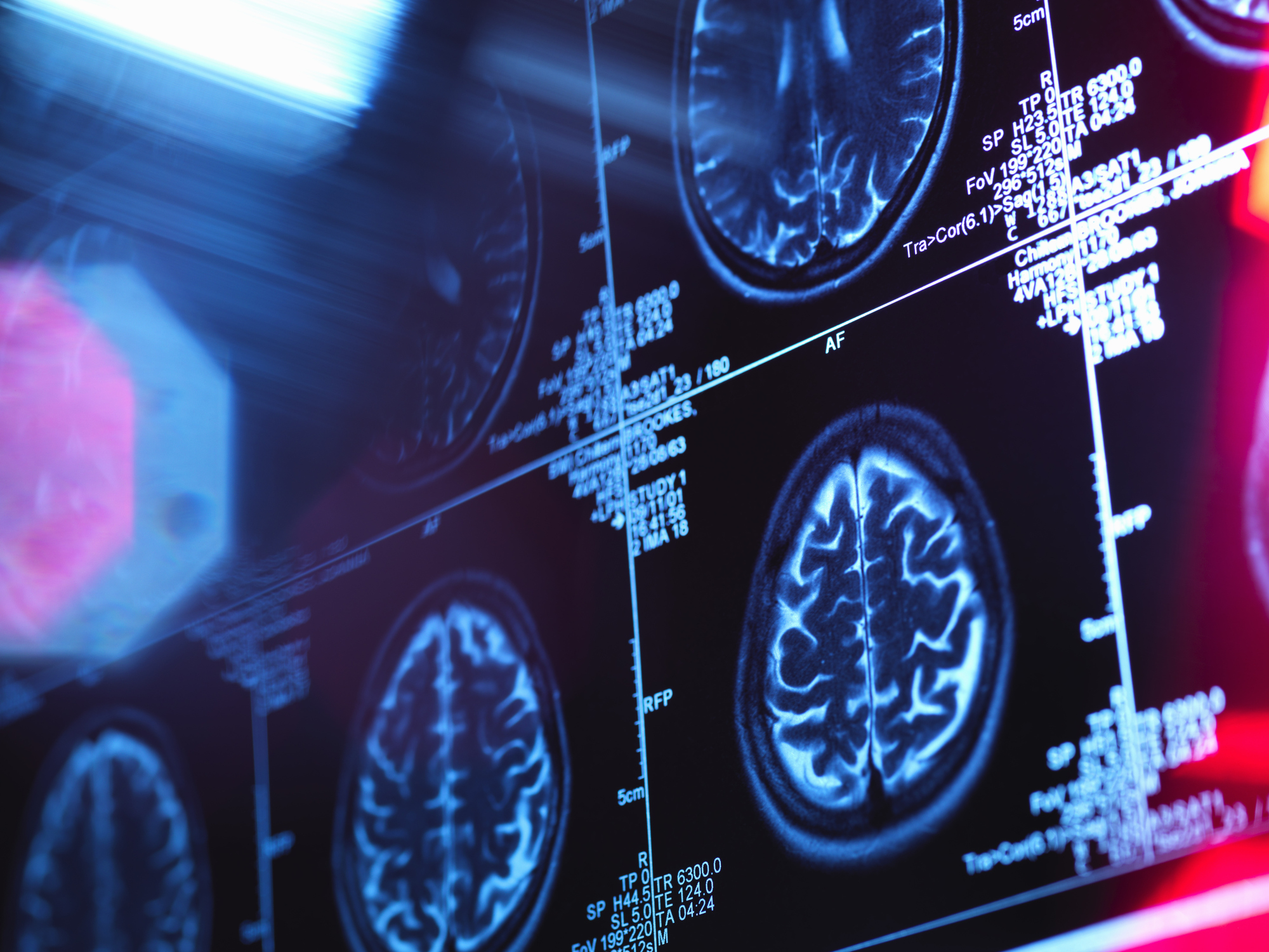 Radiology scan of human brain in a neurology clinic